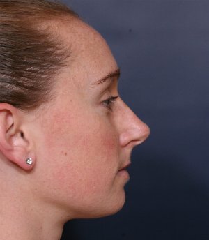 Straightening Crooked Nose - before - side
