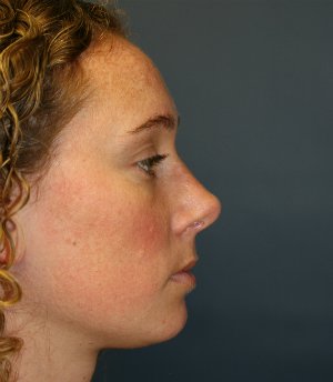 Straightening Crooked Nose - after - side