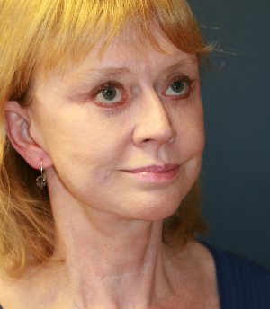 Facelift (Comprehensive) San Diego - after - oblique