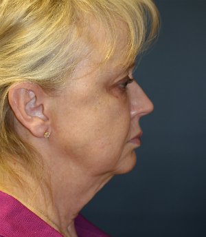 Facelift (Comprehensive) San Diego - before - side