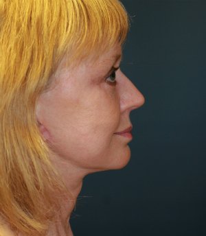 Facelift (Comprehensive) San Diego - after - side
