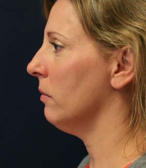 Chin Implant & Neck Lipo - before - oblique