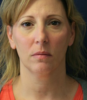 Chin Implant & Neck Lipo - before - side