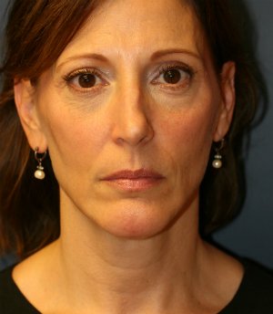 Chin Implant & Neck Lipo - after - side