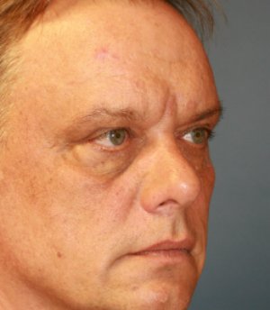 Cheek Implant & Eyelid Procedure - before - oblique