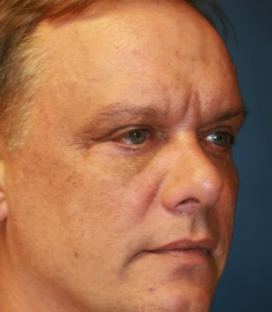 Cheek Implant & Eyelid Procedure - after - oblique