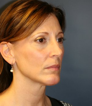 Neck Liposuction & Chin Implant - after - oblique
