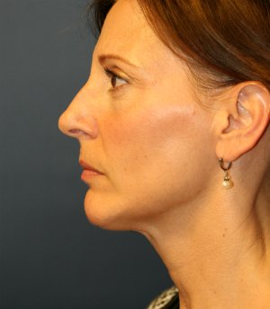 Neck Liposuction & Chin Implant - after - side