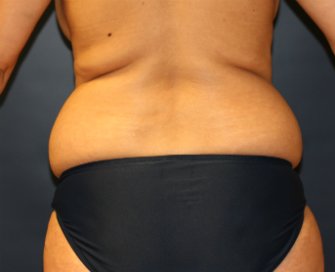 Liposuction Waist San Diego - before - front