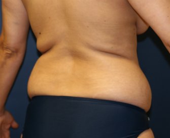 Liposuction Waist San Diego - before - oblique