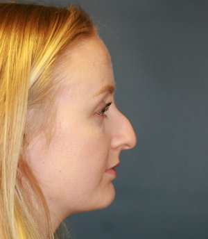 Rhinoplasty San Diego 44 - before - front