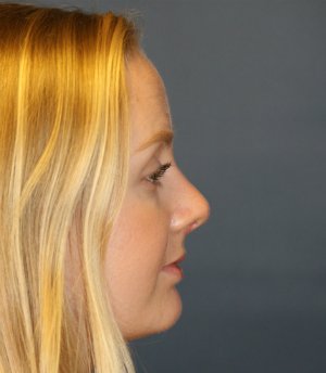 Rhinoplasty San Diego 44 - after - front