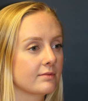 Rhinoplasty San Diego 44 - after - oblique