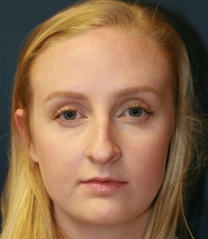 Rhinoplasty San Diego 44 - before - side