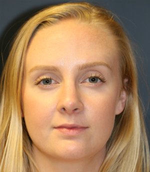 Rhinoplasty San Diego 44 - after - side