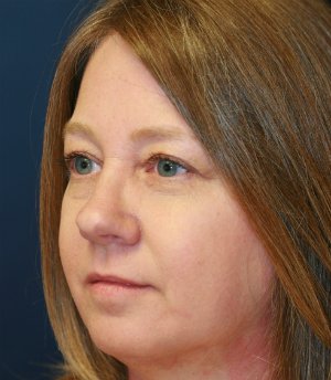 Rhinoplasty-san-diego-46 - after - oblique