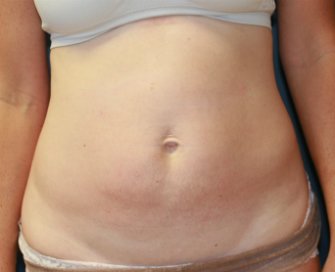 Tummy Tuck (Short Scar) San Diego 61 - before - front