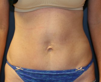 Tummy Tuck (Short Scar) San Diego 61 - after - front