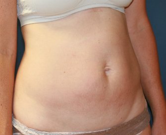 Tummy Tuck (Short Scar) San Diego 61 - before - oblique