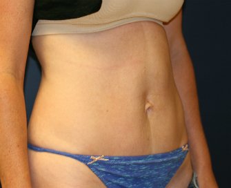 Tummy Tuck (Short Scar) San Diego 61 - after - oblique