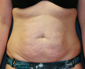 Tummy Tuck San Diego 60 - before - front