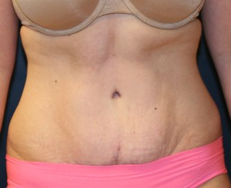 Tummy Tuck San Diego 60 - after - front