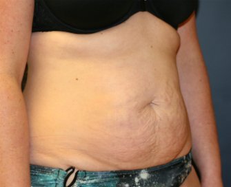 Tummy Tuck San Diego 60 - before - oblique