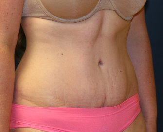Tummy Tuck San Diego 60 - after - oblique