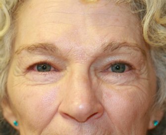 Eyelid Refresh San Diego 76 - before - front