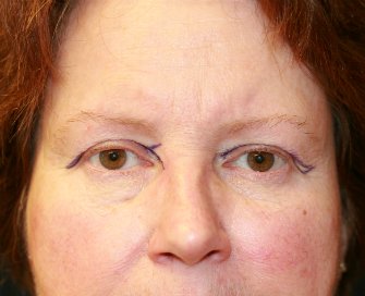 Eyelid Refresh San Diego 77 - before - front