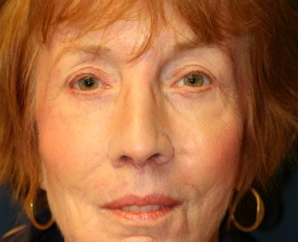 Eyelid Refresh San Diego 78 - after - front