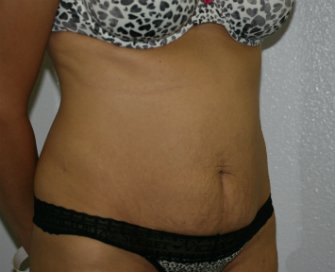 Tummy Tuck San Diego 62 - before - front