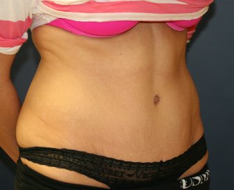 Tummy Tuck San Diego 62 - after - front