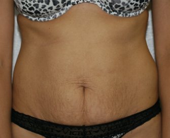 Tummy Tuck San Diego 62 - before - oblique