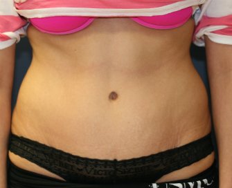 Tummy Tuck San Diego 62 - after - oblique