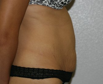 Tummy Tuck San Diego 62 - before - side