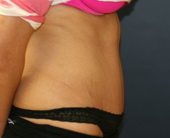 Tummy Tuck San Diego 62 - after - side