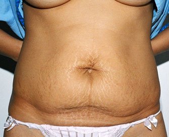 Tummy Tuck Case 5 - before - front