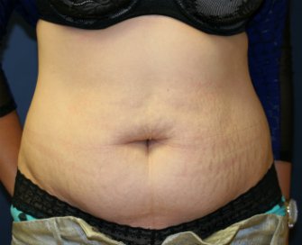Tummy Tuck San Diego 63 - before - oblique