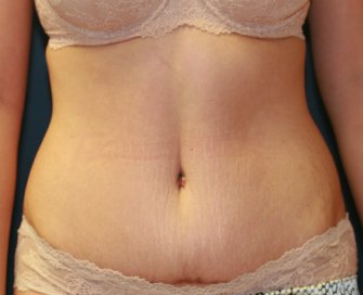 Tummy Tuck San Diego 63 - after - oblique