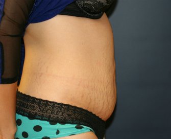 Tummy Tuck San Diego 63 - before - side