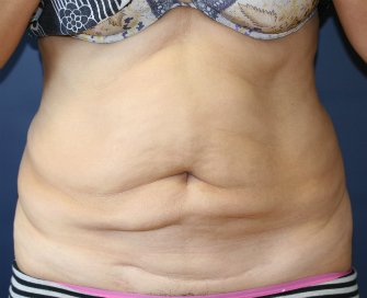 Tummy Tuck San Diego 65 - before - front