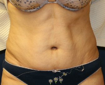 Tummy Tuck San Diego 65 - after - front