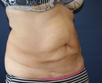 Tummy Tuck San Diego 65 - before - oblique