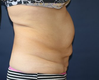 Tummy Tuck San Diego 65 - before - side