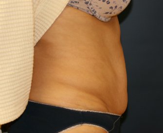 Tummy Tuck San Diego 65 - after - side
