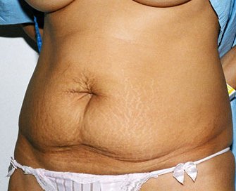 Tummy Tuck Case 5 - before - angle