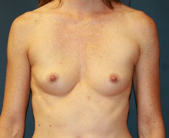 High (Full) Profile Breast Augmentation - before - front