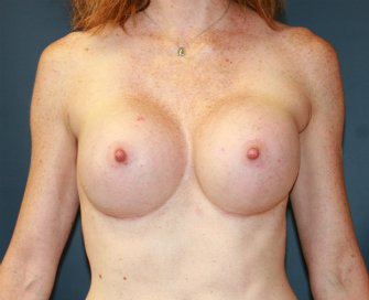 High (Full) Profile Breast Augmentation - after - front