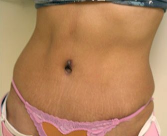 Tummy Tuck Case 5 - after - angle